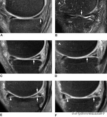 为什么春季膝关节比平时疼得厉害,膝关节凉嗖嗖的疼是什么病