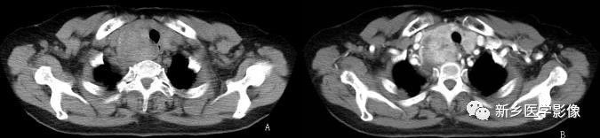 前上纵隔高密度影考虑胸腺未退化,肺纵隔胸腺结节12mm看什么科