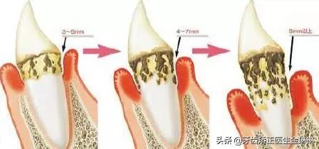 有肾病的人得了牙周炎怎么办,得了牙周炎用什么牙膏刷牙最好