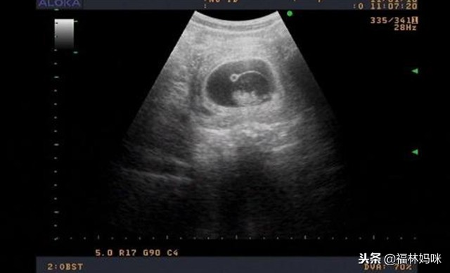 孕妇孕酮低胎儿能保住吗,孕检发现胎盘低怎么办