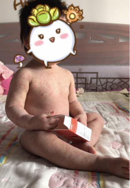 二宝妈妈教你护肤,过敏宝宝的育儿分享