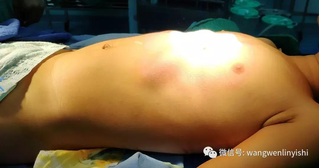 肋弓凹陷手术后需要取东西么,肋弓隆起手术