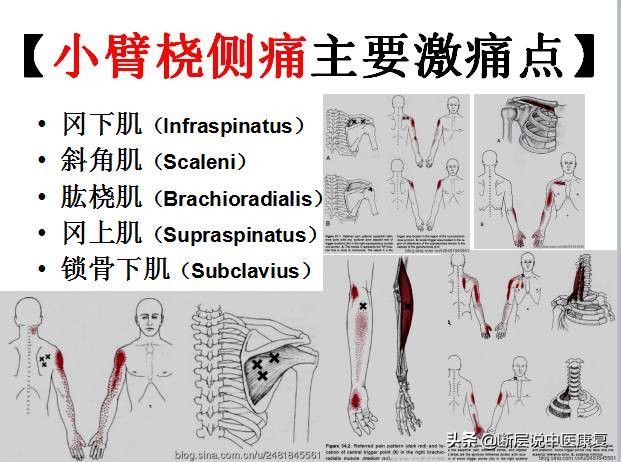激痛点挂图,激痛点疗法笔记