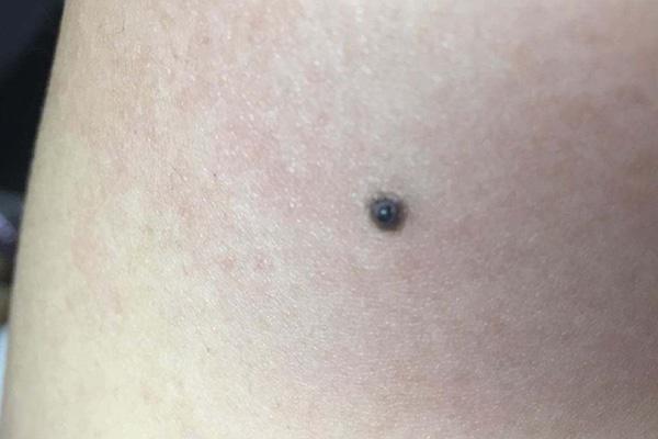 黑痣越来越大恶变的几率有多大,什么样的黑痣会有癌变的可能