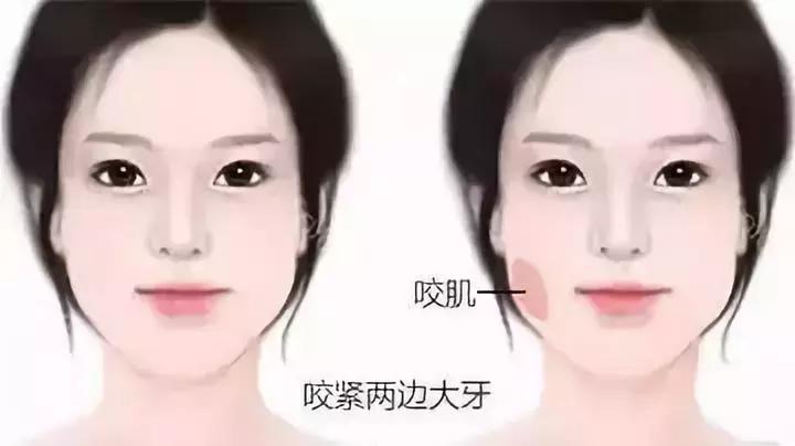 进口瘦脸针和国产瘦脸针区别,国产和进口瘦脸针效果一样吗