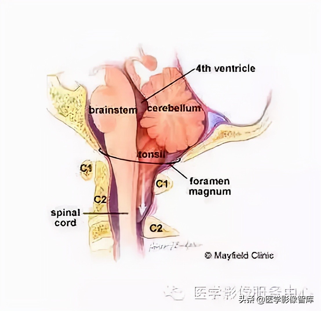 chiari畸形确诊,chiari畸形症状会一直有吗