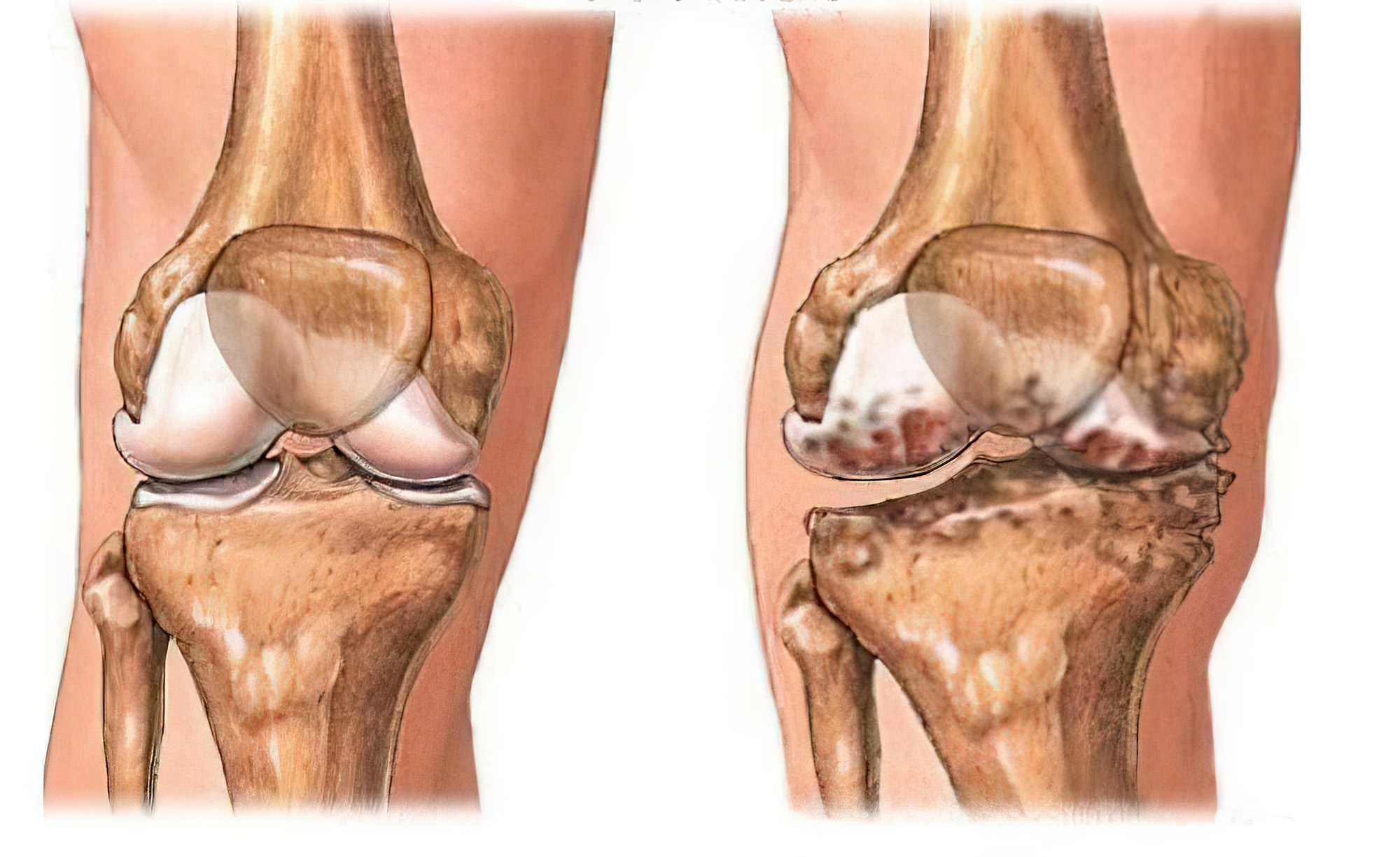 卢老太治骨病,膝盖骨刺和增生打针和理疗哪个好