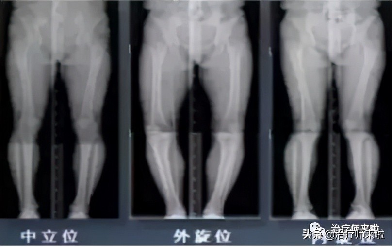 怎样可以使腿型更直,如何使腿型更好