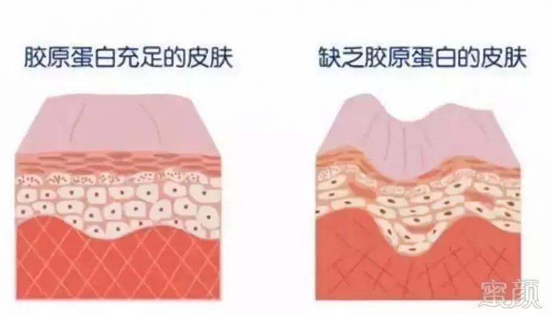 热拉提超声刀热玛吉,超声刀热玛吉真的有用吗