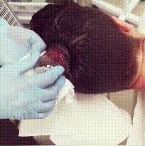 邓莎被烧伤原因,邓莎拔火罐被烧伤视频