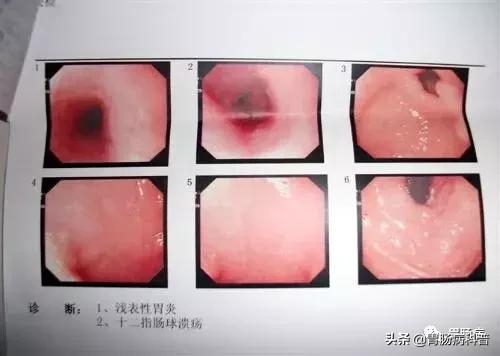 浅表非萎缩性胃炎严重吗怎样治疗,非萎缩胃炎和浅表性胃炎哪个严重