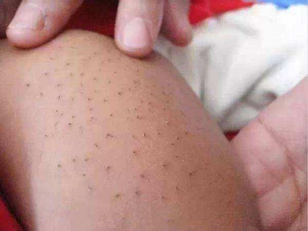 猪毛风婴儿,新生儿身上有猪毛风是怎么来的
