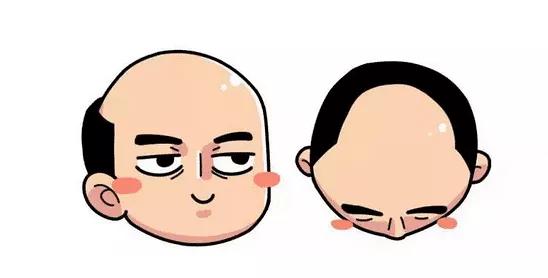 雄激素性脱发秃顶用什么能生发,雄激素性脱发科普