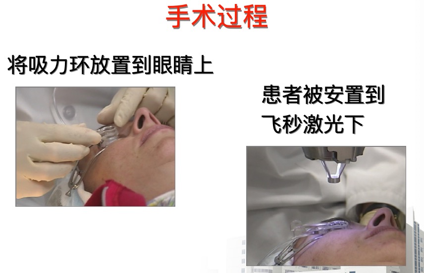 做过lasik手术后还可以做飞秒吗,lasik激光近视眼手术有什么优势