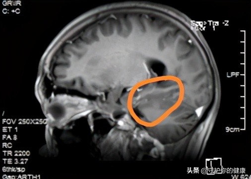 脑转移不能放疗了怎么办,脑转移不治疗的生存期