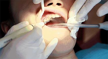 不做根管治疗直接补牙有什么危害,牙疼根管治疗后还疼什么原因