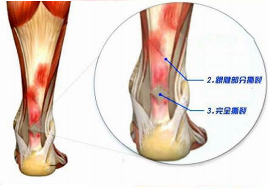 运动员脚趾受伤,运动员手筋受伤