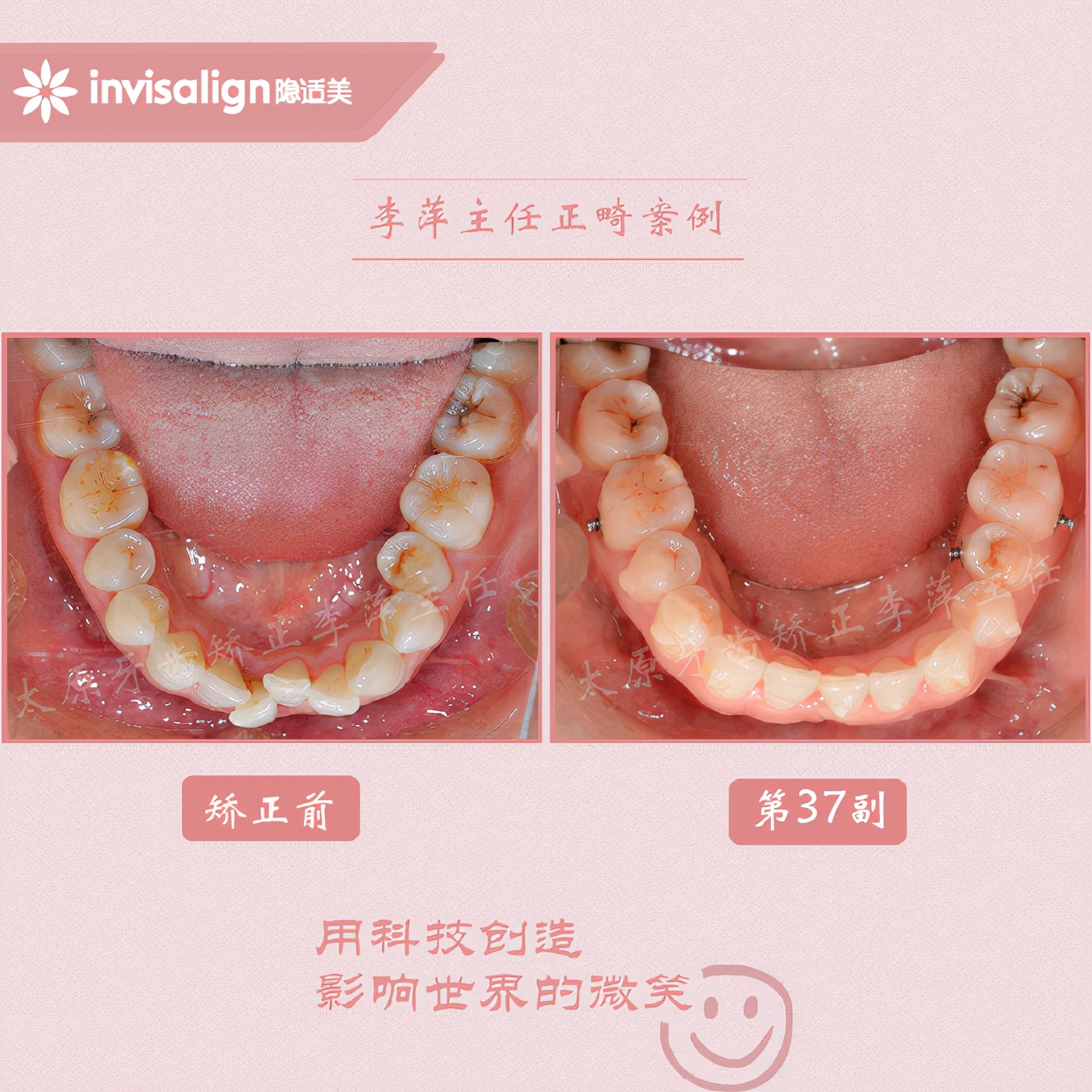 改善一侧咬肌,如何改善面型