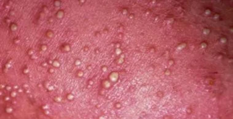 热痱子与汗疱疹的区别,汗疱疹和痱子的区别