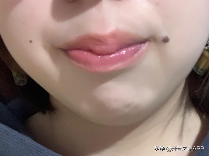 不靠整容怎么改变下巴后缩？看这里