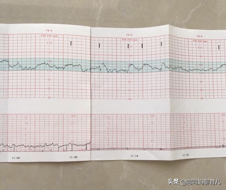 孕晚期胎监不过需要做什么检查,孕晚期胎监不好医生要催生
