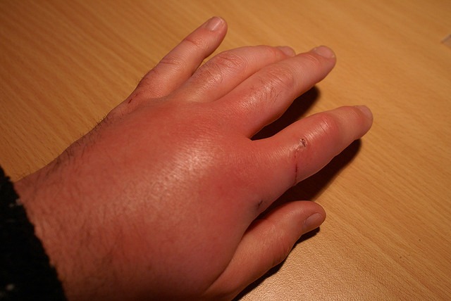 怎么治猫虫,被猫虱子叮咬怎样治疗