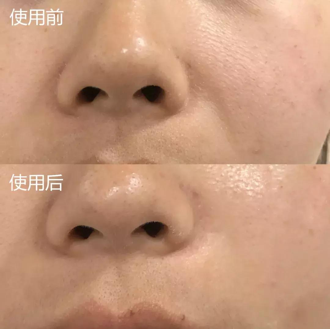 护肤黑科技顶级医美,用黑科技去除眼袋肿了十天