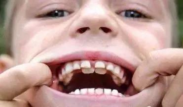 4岁儿童长出“双排牙”不得不一一拔掉！爸妈：只怪我们太宠溺