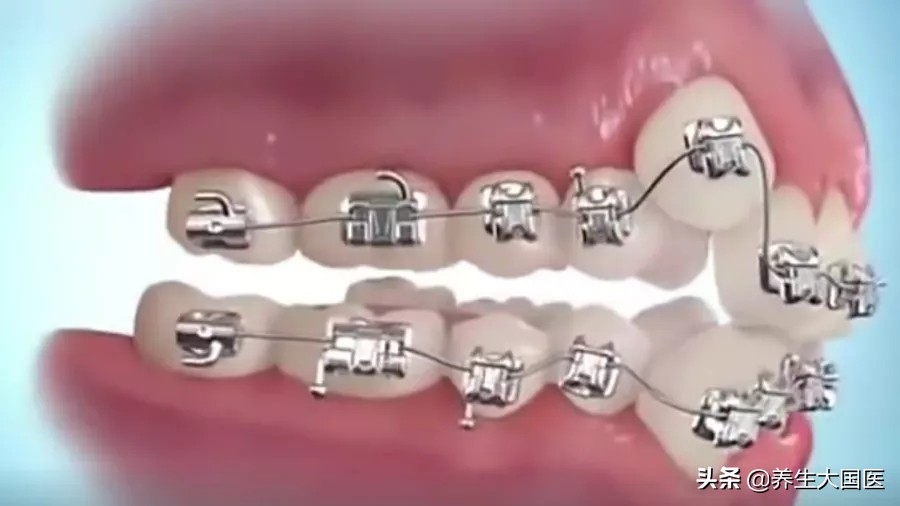 各种牙齿矫正的优缺点,牙齿矫正后对面部有改善吗