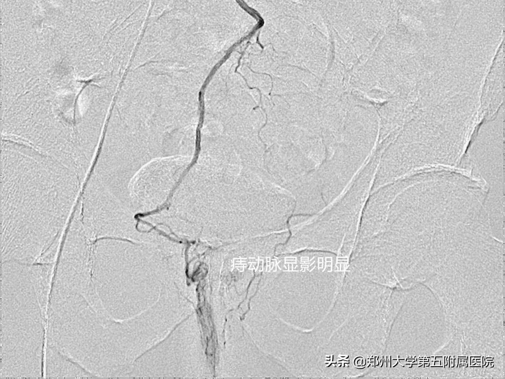 有痔之士的中医护肛妙方,有没有痔疮经过保守治疗不痛苦的