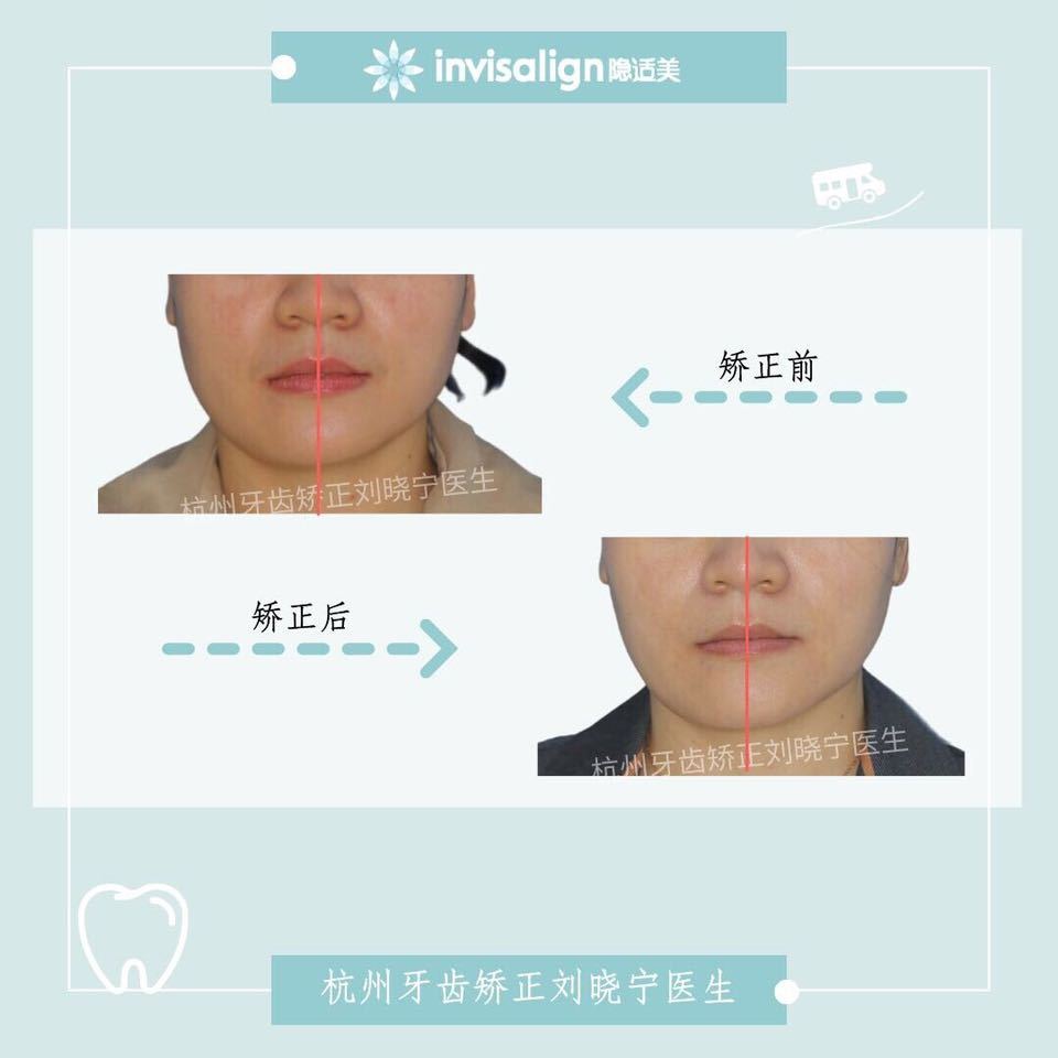 杭州牙齿深覆合矫正,杭州牙齿矫正有什么方法