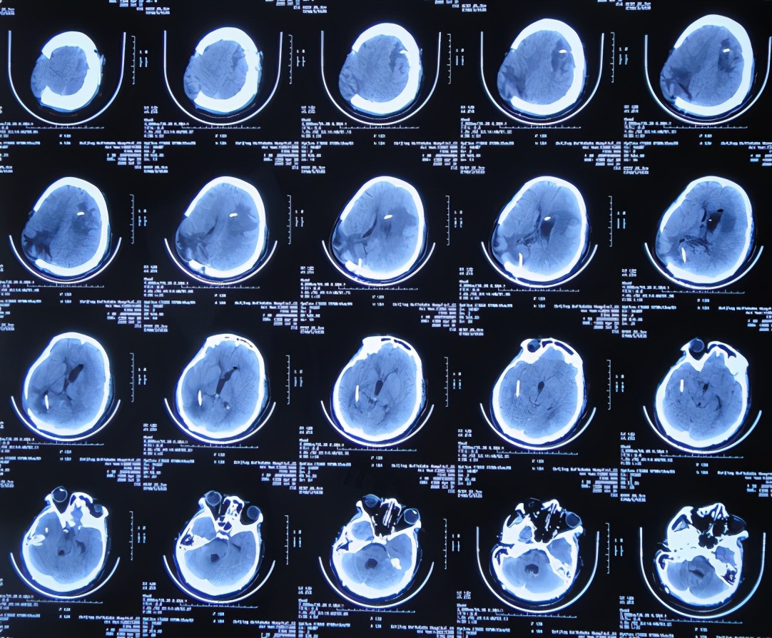 脑室有粘连脑积水有什么办法,脑动脉畸形手术后出现急性脑积水
