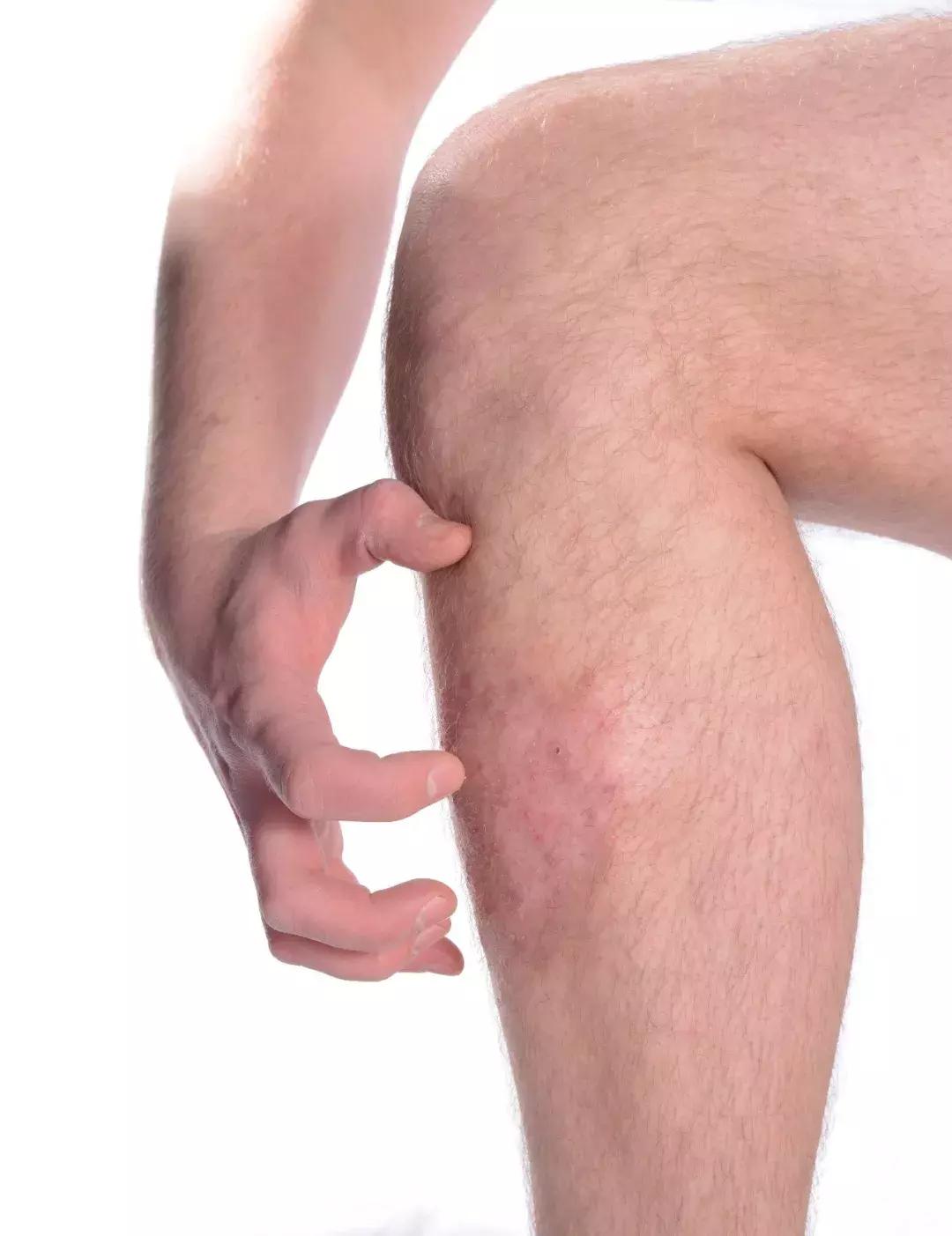 *麻疹荨**的诊断与治疗