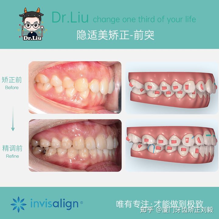 正畸临床拔牙矫治,拔牙正畸矫正嘴凸案例