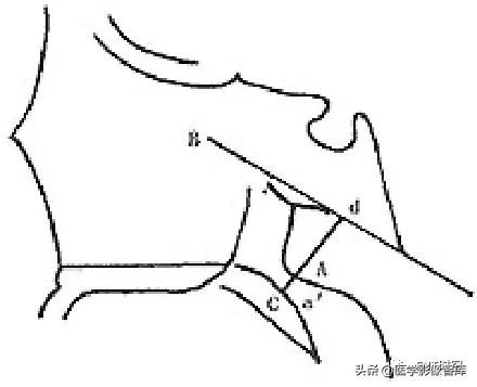 腺样体肥大有必要做x射线复查吗,最简单检测腺样体肥大的方法