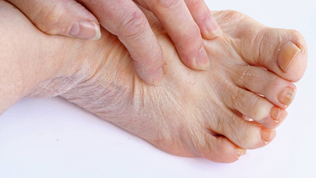 身体干脱皮吃什么食疗好,手脚干燥是缺乏什么引起的