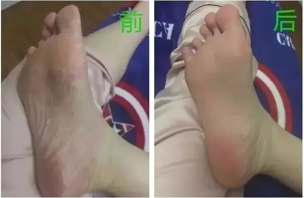 后脚跟干裂护足霜排行榜第一名,护脚霜脚后跟干裂修复霜国货