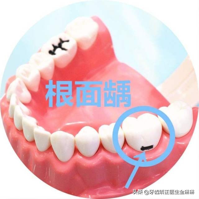 牙齿根部烂掉什么原因,牙总是掉碎块是怎么回事