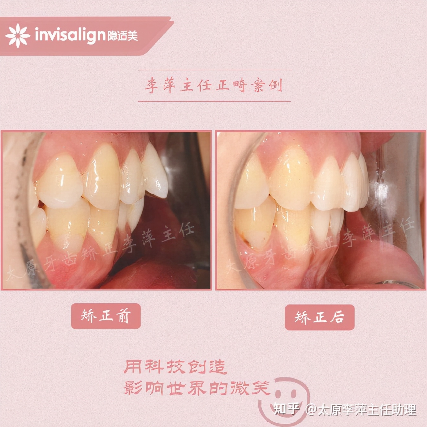 太原牙齿矫正靠谱吗,太原成人隐形牙套牙齿不齐