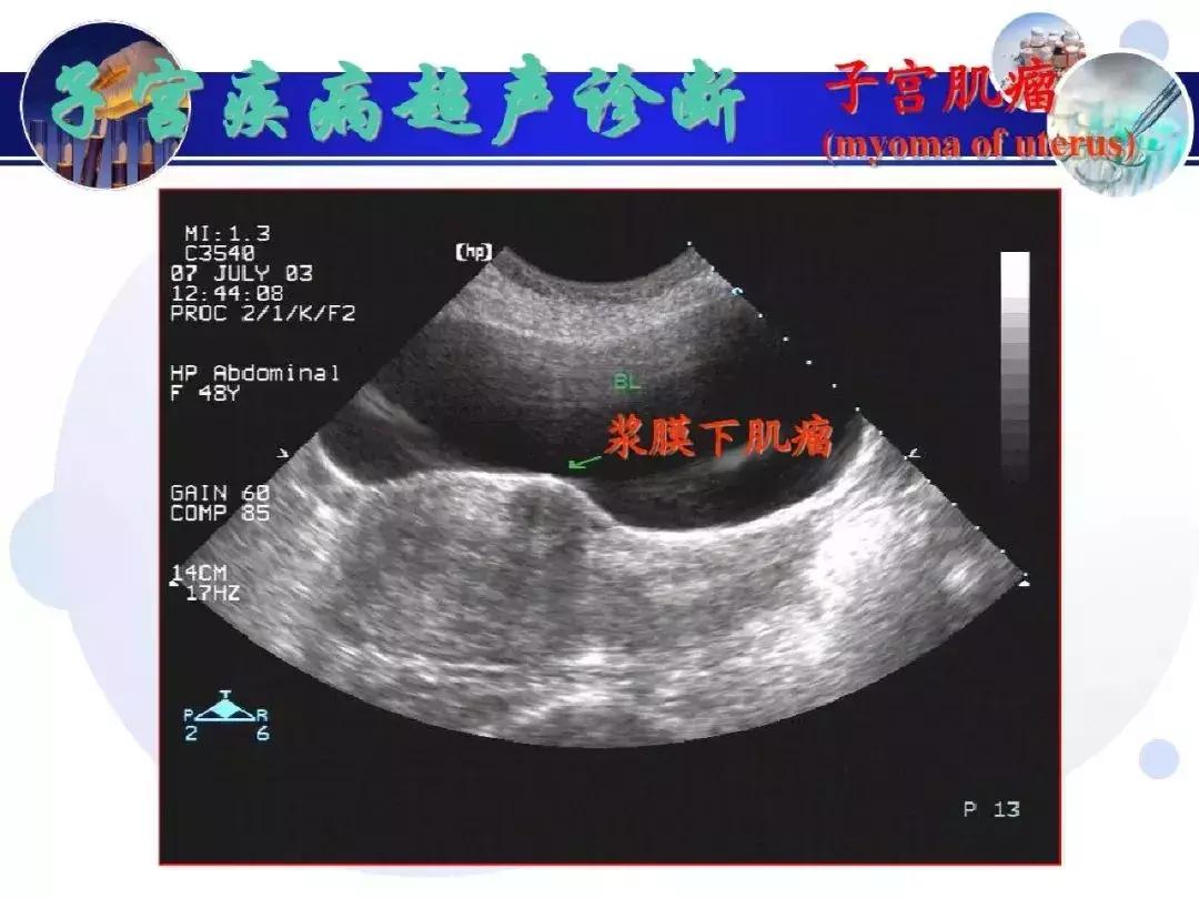 纯干货！子宫及附件解剖和超声诊断
