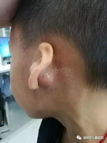 5岁孩子感冒后鼻子里面发红肿大,小孩子发烧后耳朵后面长大包