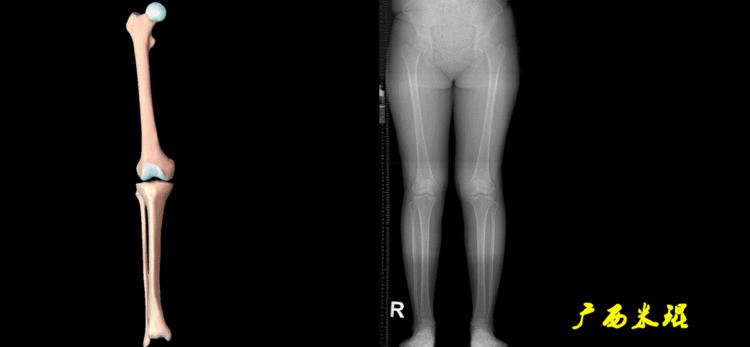 广西骨科医生米琨最新信息,米琨广西骨科什么水平