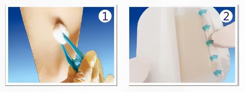 下肢静脉淤积性溃疡,下肢静脉性溃疡挂哪个科