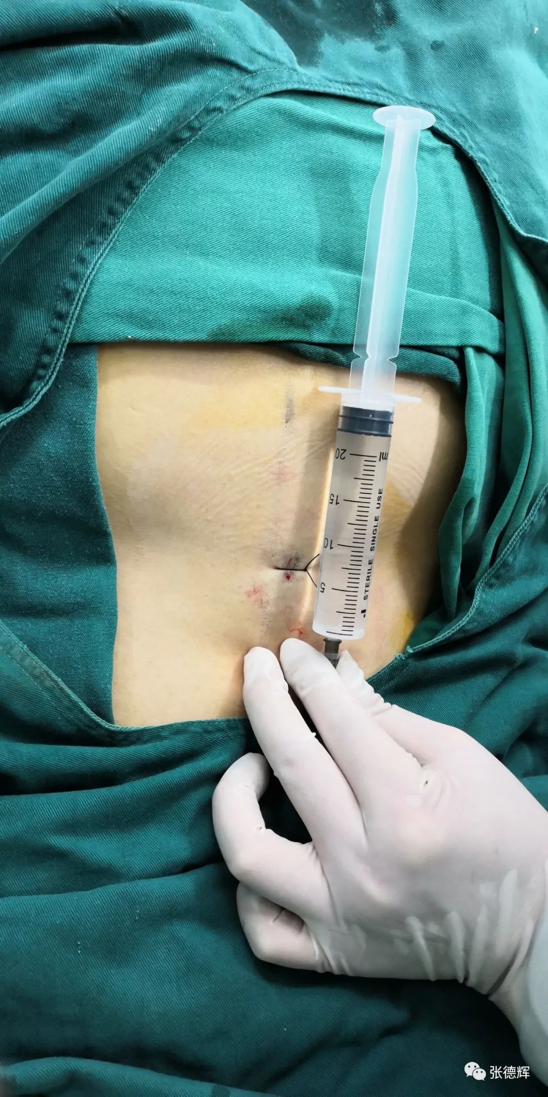 腰椎间盘突出症脊柱内镜微创手术后路镜下视频演示