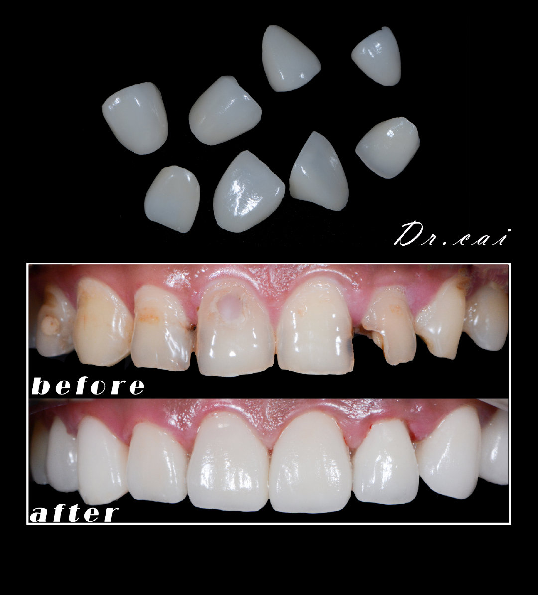 树脂贴面和烤瓷贴区别,贴面树脂的好还是烤瓷的好