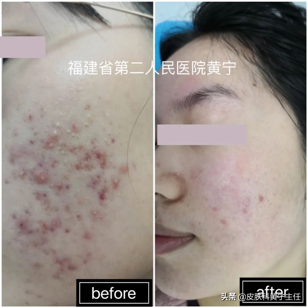 宅家的1个多月都没化妆,竟然还爆痘