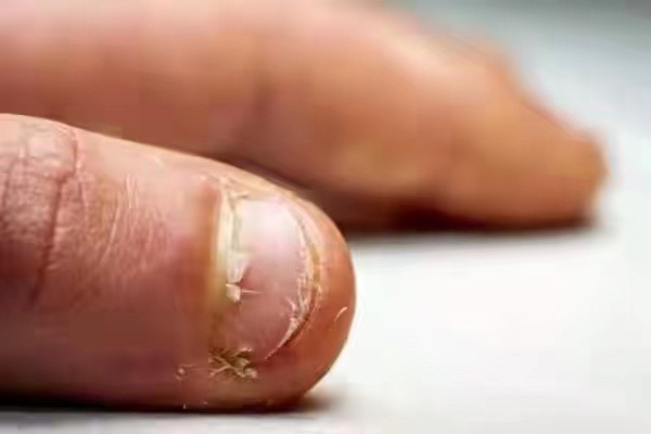 被鱼刺扎了手发紫了可以治疗好吗,被鱼刺扎破手有危险么