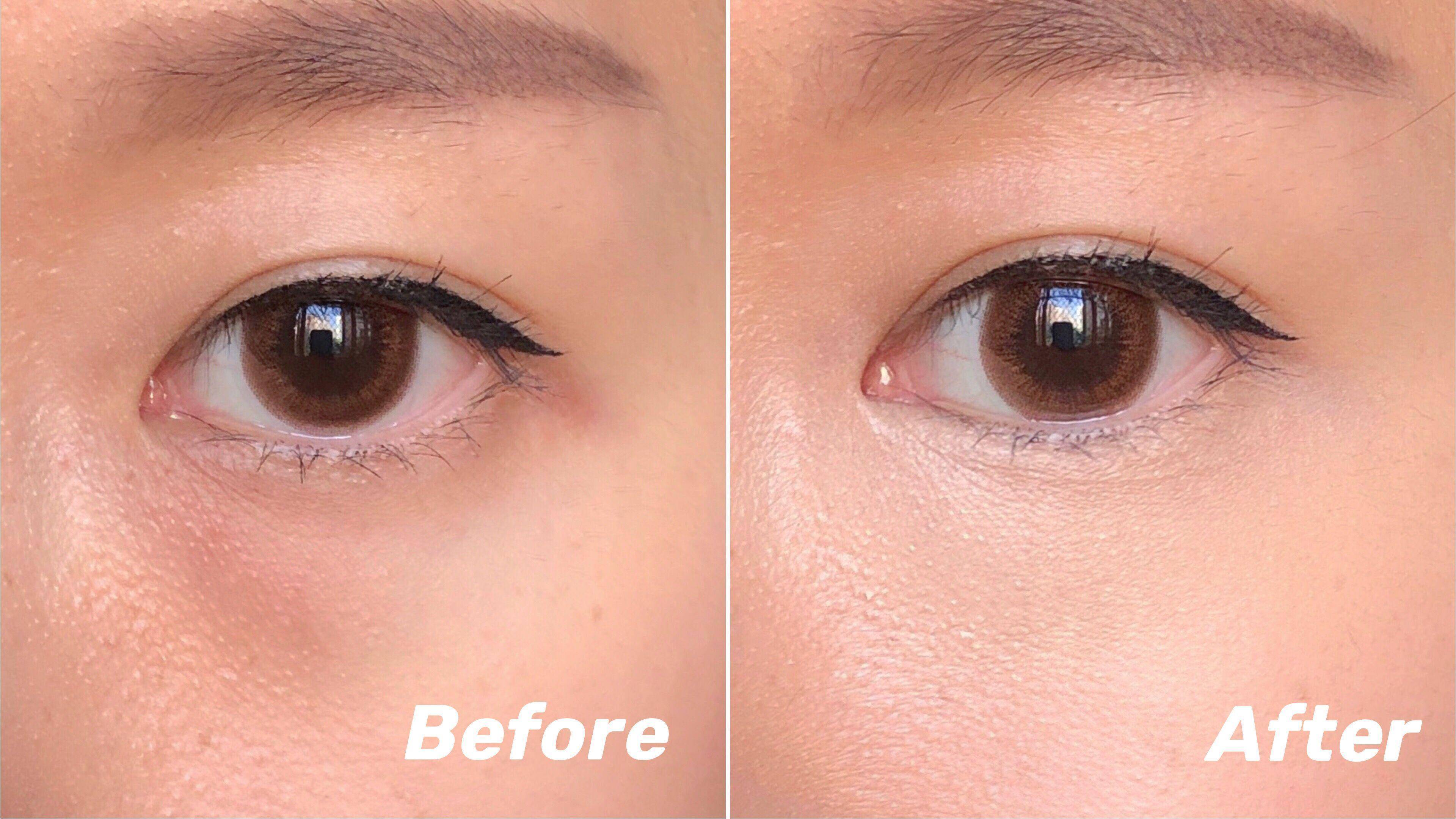 严重泪沟黑眼圈,淡化黑眼圈和泪沟原理