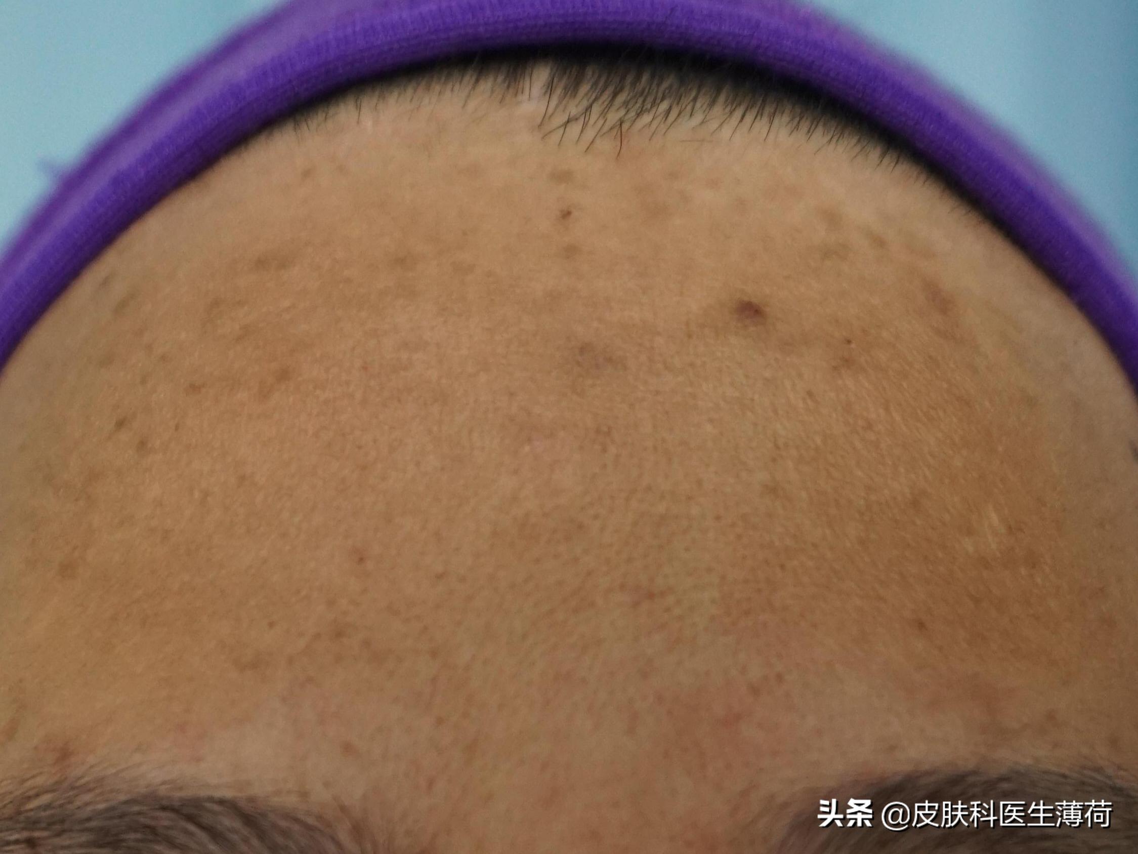 皮肤科医生推荐的去痘印的药,皮肤痘印怎么做才能彻底修复