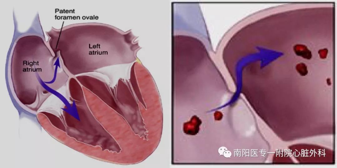 卵圆孔未闭封堵手术会脑血栓吗,心脏卵圆孔封堵术